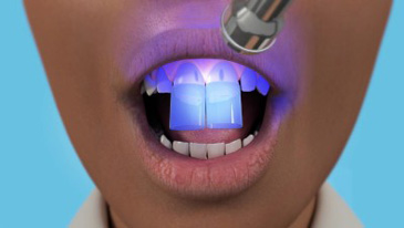 Porcelain Veneers